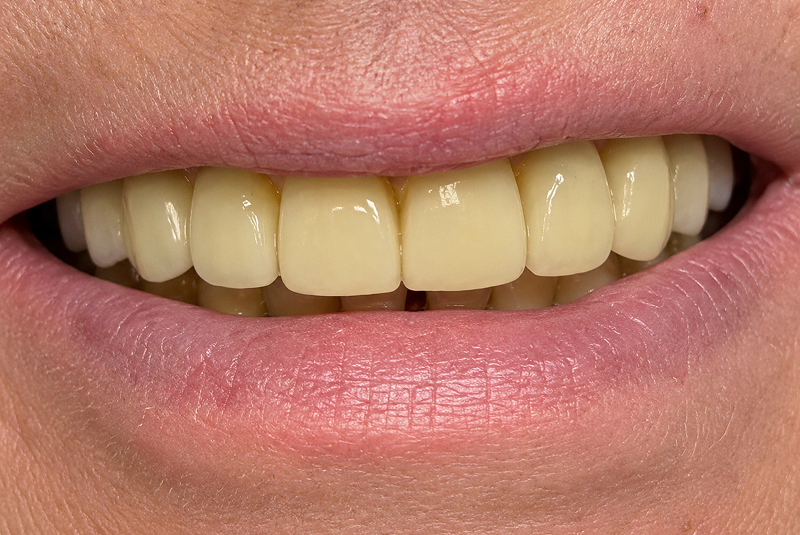 After - smile fixed